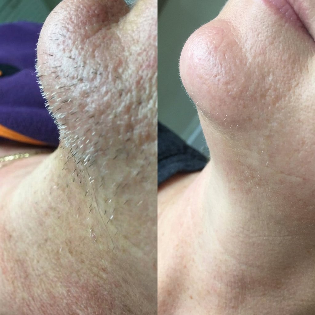 Gros plan éditorial sur une zone de menton et de mâchoire chez une femme d'une cinquantaine d'années, poils foncés visibles