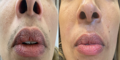 Mélissa R., 29 ans · Menton / lèvre supérieure